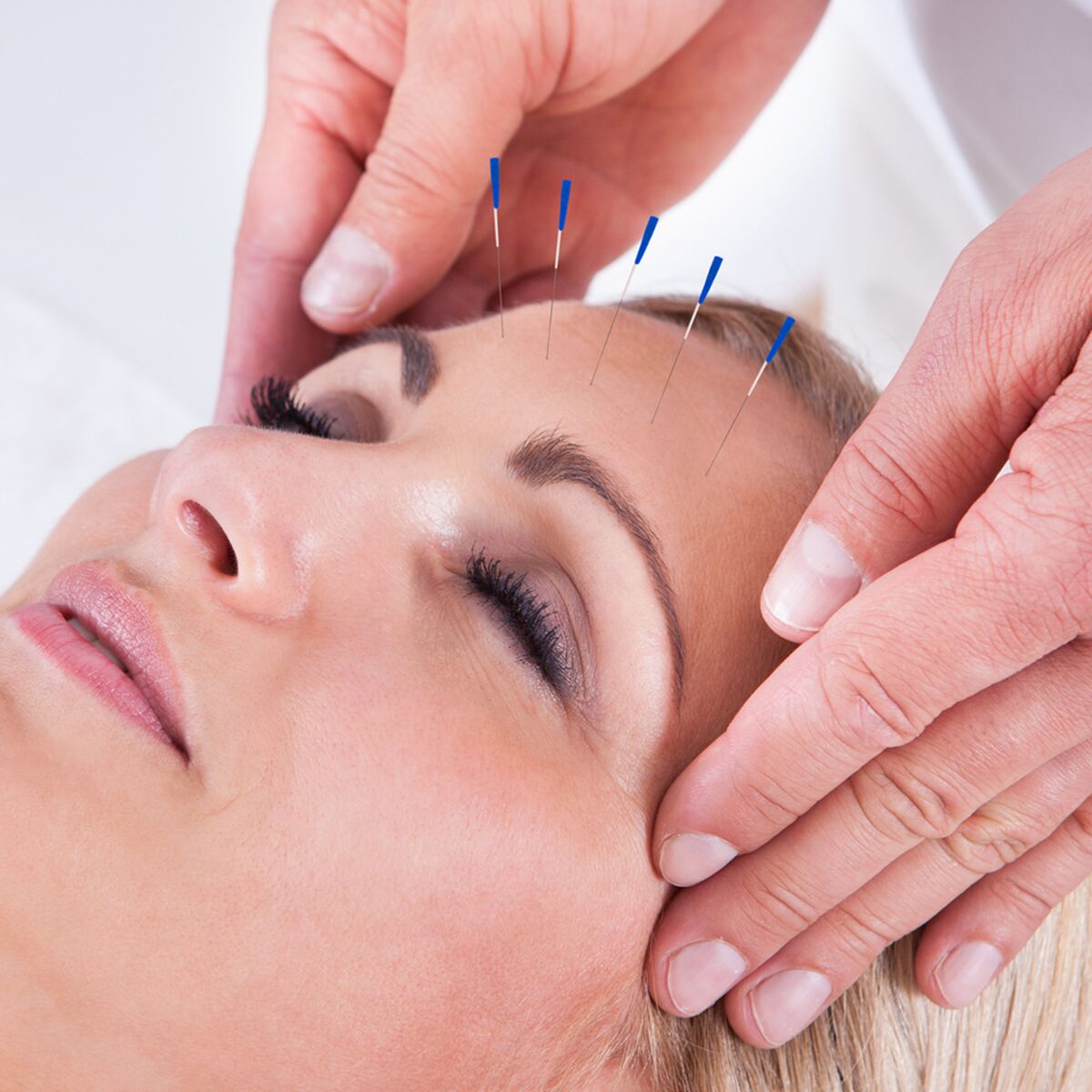 طب سوزنی راه حل درمان میگرن در طب سوزنی طب سوزنی راه حل درمان میگرن در طب سوزنی